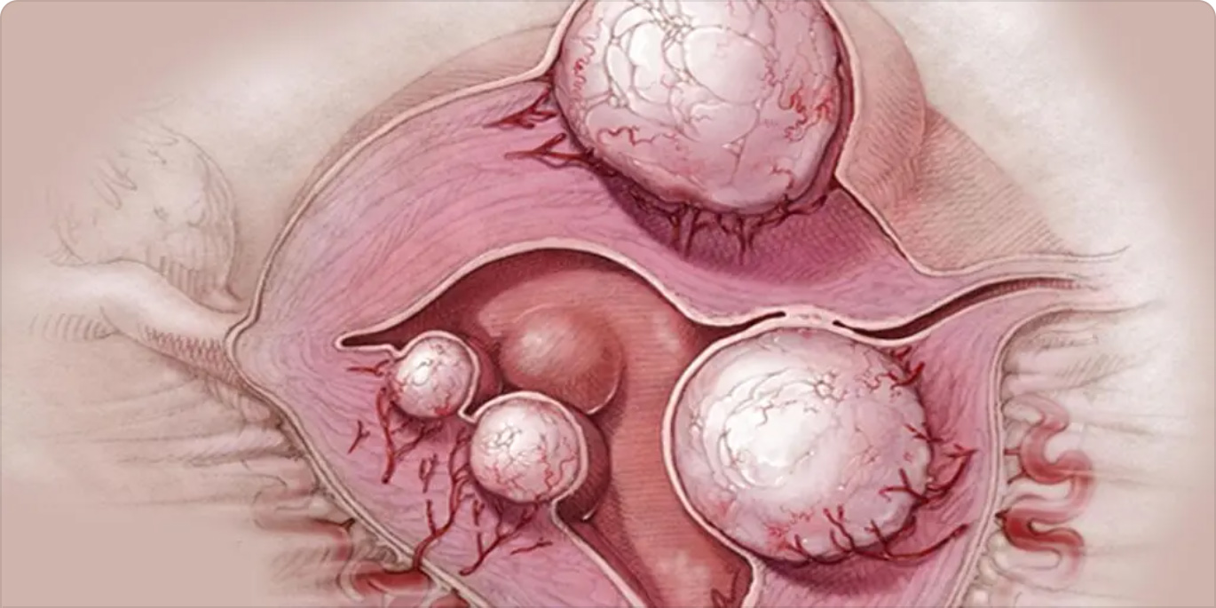Забеременеть с полипом в матке. Эндометриоидная киста яичника эндометриоидная киста. Эндометриоз киста яичника. Эндометриалтные опухоли яичников.